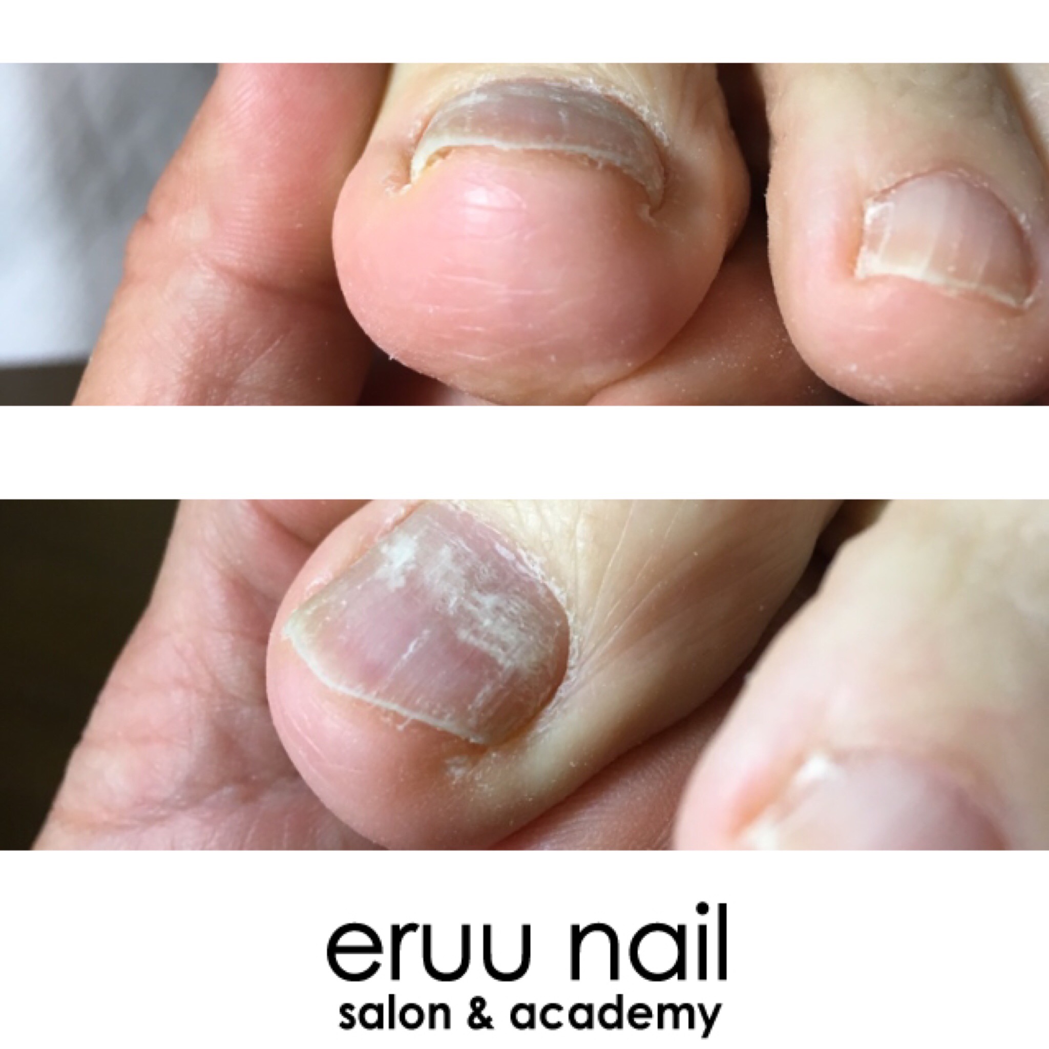 深爪しちゃいけないのはどうして 茅ヶ崎のネイルサロン Eruu Nail